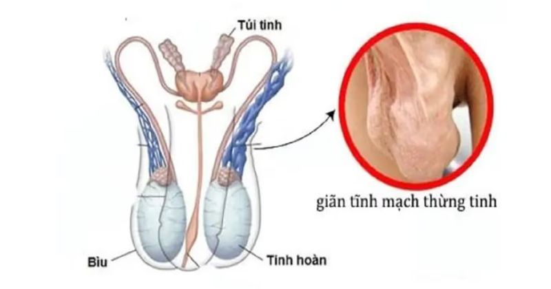 Giãn tĩnh mạch thừng tinh