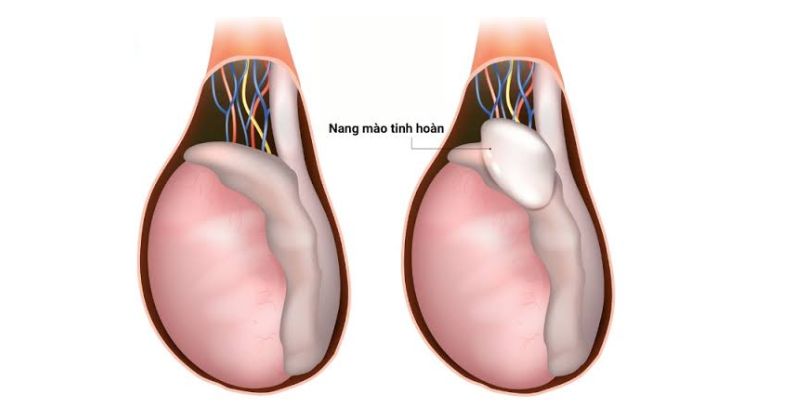 Nang mào tinh hoàn