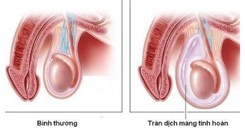 Tràn dịch màng tinh hoàn