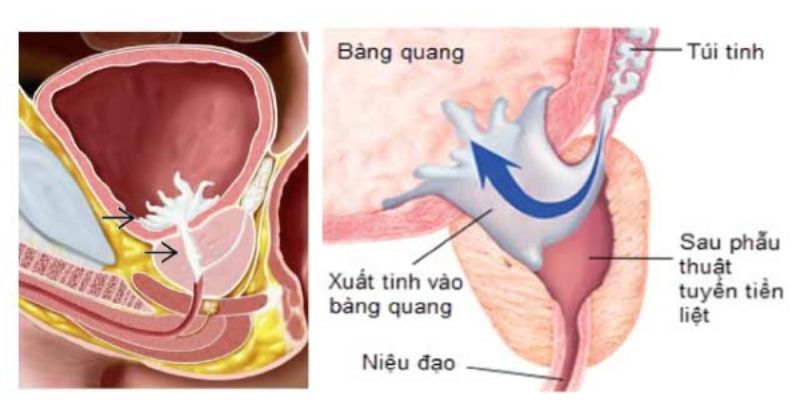 Xuất tinh ngược dòng